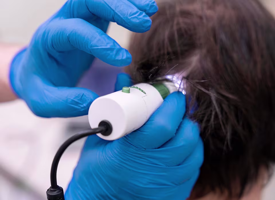 Як проходить лазерне лікування випадіння волосся