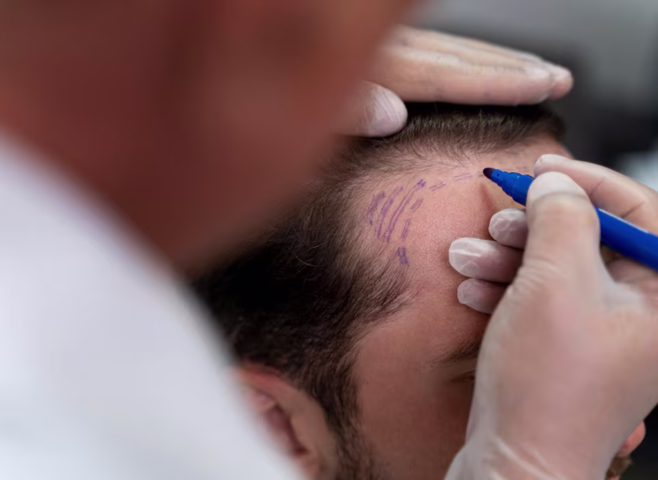 Методи трансплантації волосся