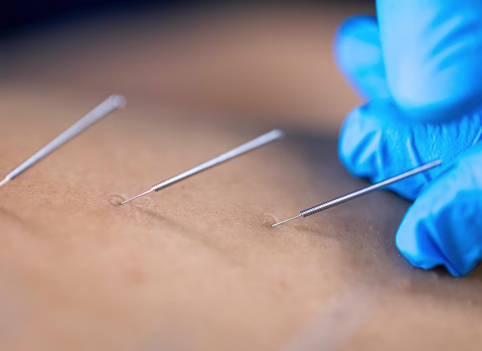 Важливі особливості видалення родимок