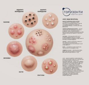 Акне, постакне та висипання