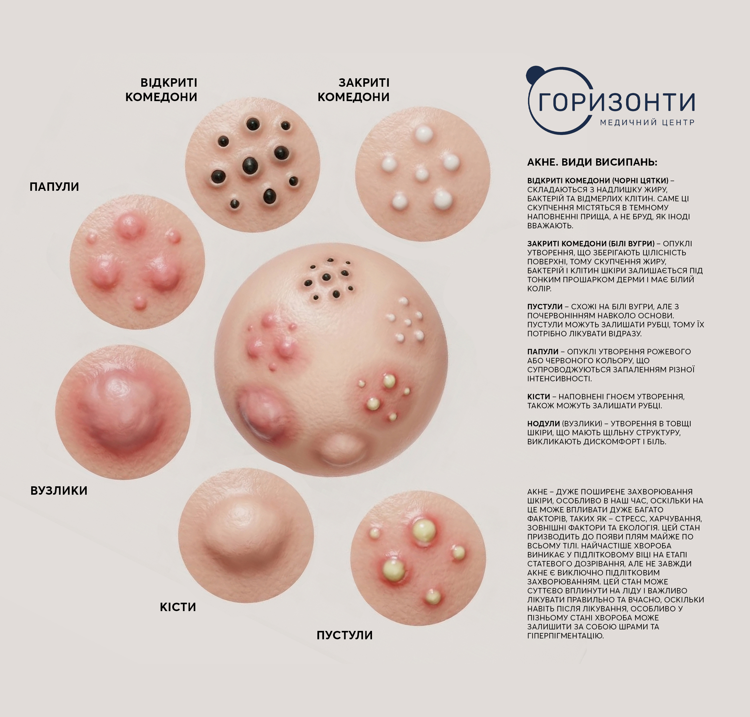 Акне, постакне та висипання